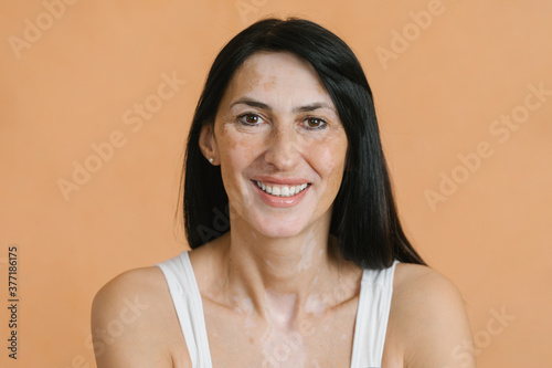 Vitiligo skin