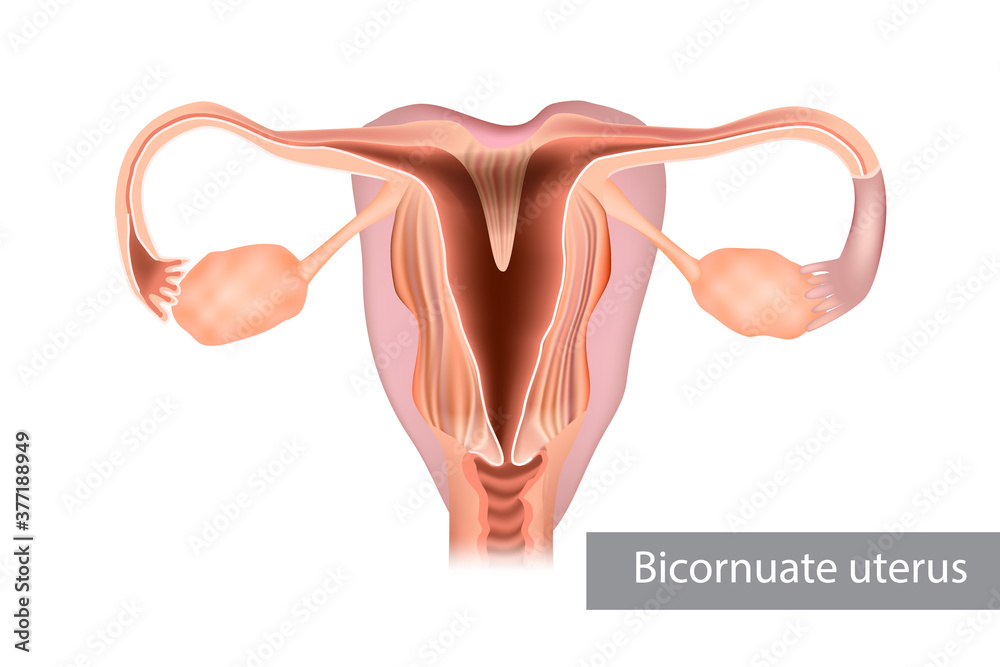 A bicornuate uterus or bicornate uterus is a type of mullerian anomaly in the human uterus