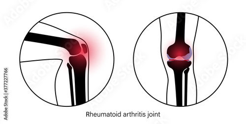 Arthritis in knee joint