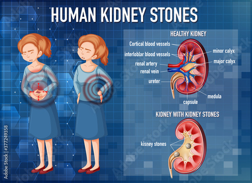Informative illustration of kidney stones