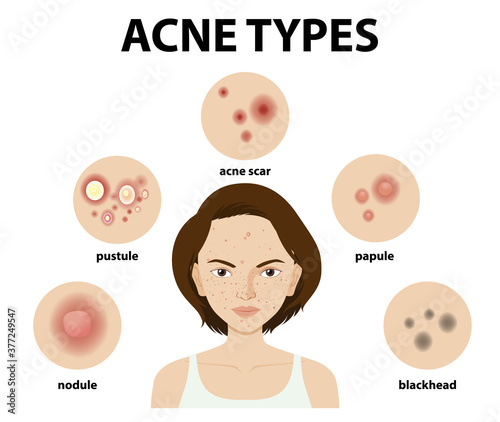 Types of acne on the skin or pimples