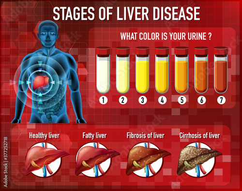 Stages of liver disease