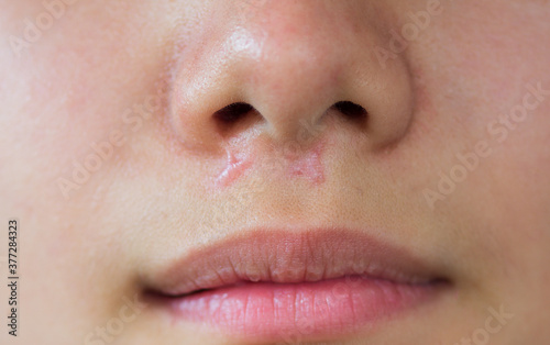 close-up keloids scars on face skin