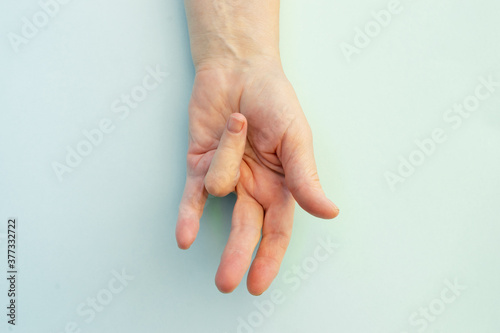 Hands of a woman with twisted fingers. Dupuytren's contracture disease. photo