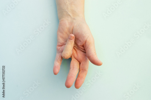 Hands of a woman with twisted fingers. Dupuytren's contracture disease.