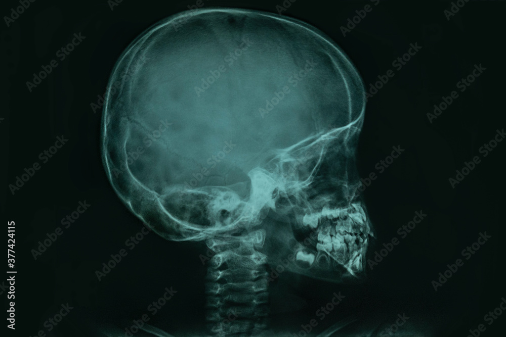 Skull xray scan Skull xray scan