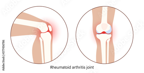 Arthritis in knee joint