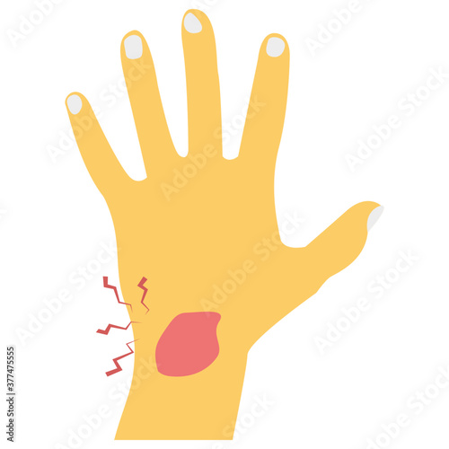 Hand Bleeding