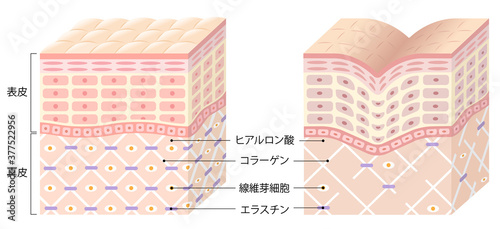 しわ　肌の断面図　ビフォアアフター