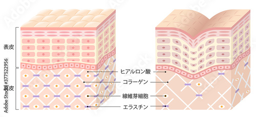 しわ 肌の断面図 ビフォアアフター