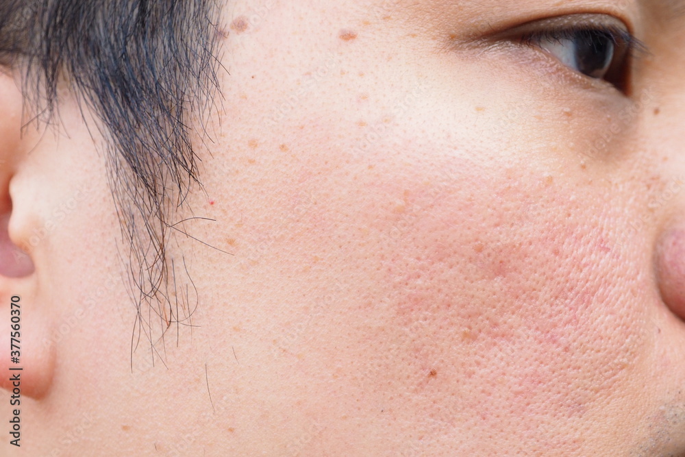 Closeup of red skin with acne, pores and moles on the face of a young Asian man. Health, medical, beauty, aesthetics concept Closeup of red skin with acne, pores and moles on the face of a young Asian man. Health, medical, beauty, aesthetics concept