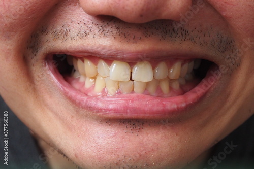 Young man smiling showing his yellow teeth and some plaque. Need to see dentist for teeth treatment and mouth cleaning