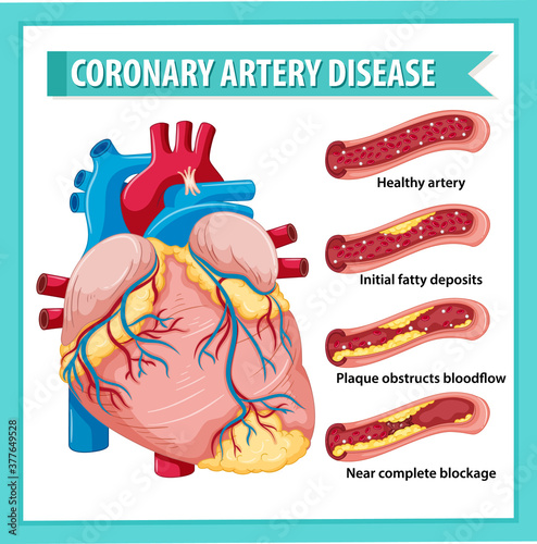 Coronary Artery Disease for health education Infographic