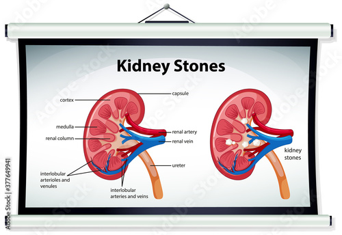 Kidney stones symptoms cartoon style infographic