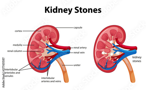 Kidney stones symptoms cartoon style infographic photo