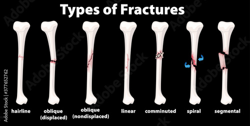Type of Fractures diagram