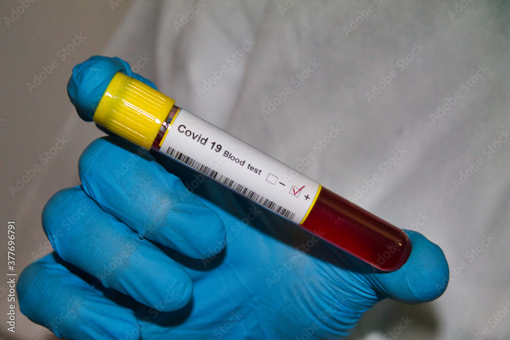 Obraz premium BLOOD TEST CORONA VIRUS 19