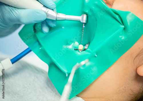 Fotografie Treatment of dental canals in the bottom molar permanent mola…