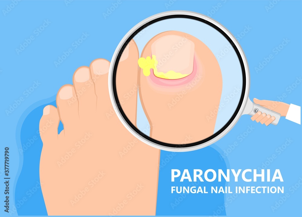 skin finger nail toes symptom injuries pus drain treatment treat fluid