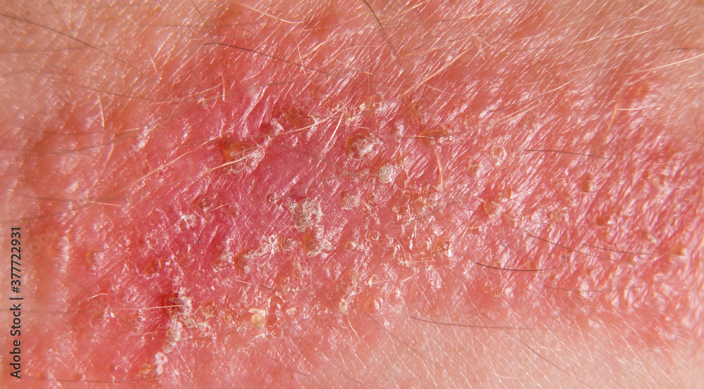 Poison Oak, Poison Sumac, or Poison Ivy rash. Macro view of painful red
