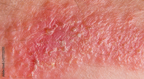 Poison Oak, Poison Sumac, or Poison Ivy rash.  Macro view of painful red welts developed after contact with urushiol, the oil in the plant that causes an allergic reaction.  Scabs and blisters on skin photo