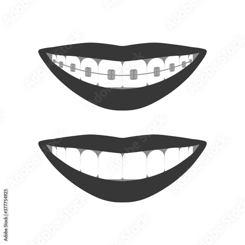 Teeth in the mouth with or without braces. During and after orthodontic treatment. The alignment of the teeth. Healthy lifestyle and dental care. White even teeth in a smile. Isolated flat vector