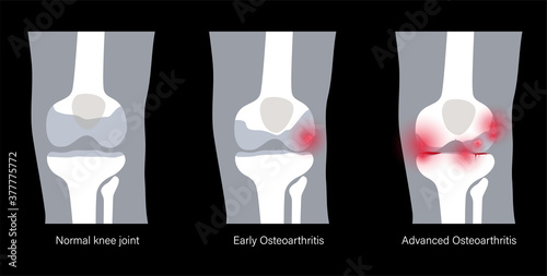 Arthritis in knee joint