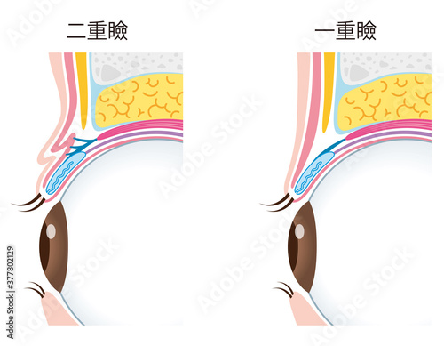 Fototapet 二重瞼と一重瞼の構造　比較　まぶた　断面図