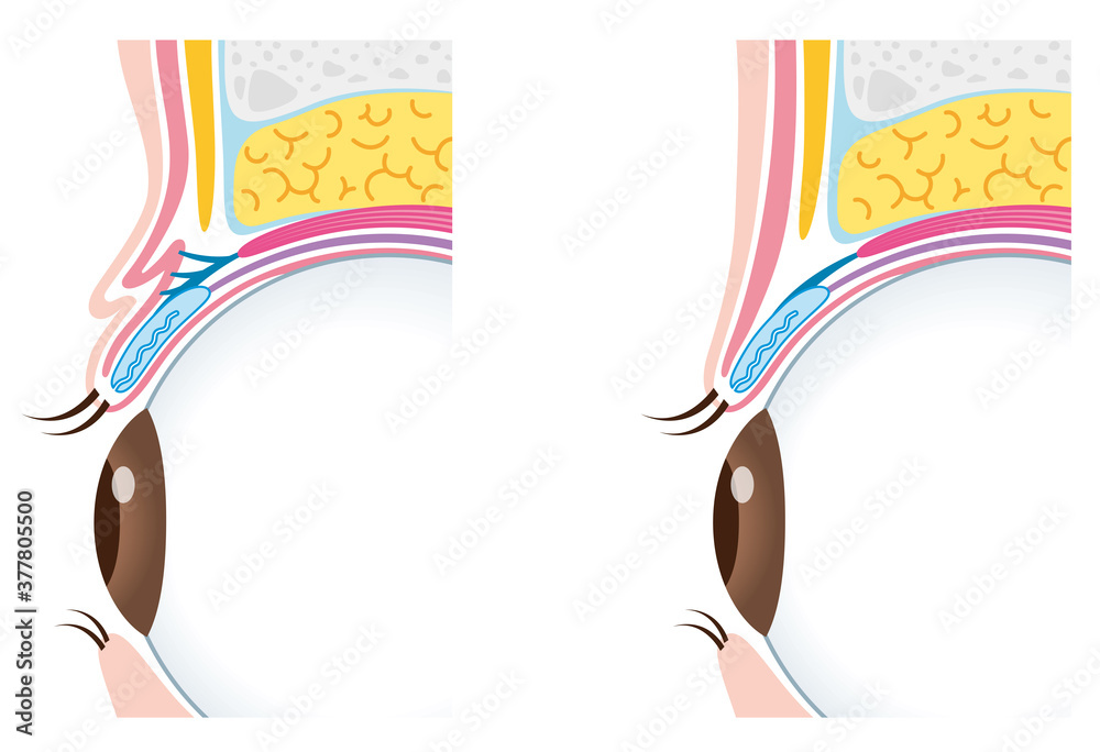 二重瞼と一重瞼の構造 比較 まぶた 断面図 Stock Illustration Adobe Stock