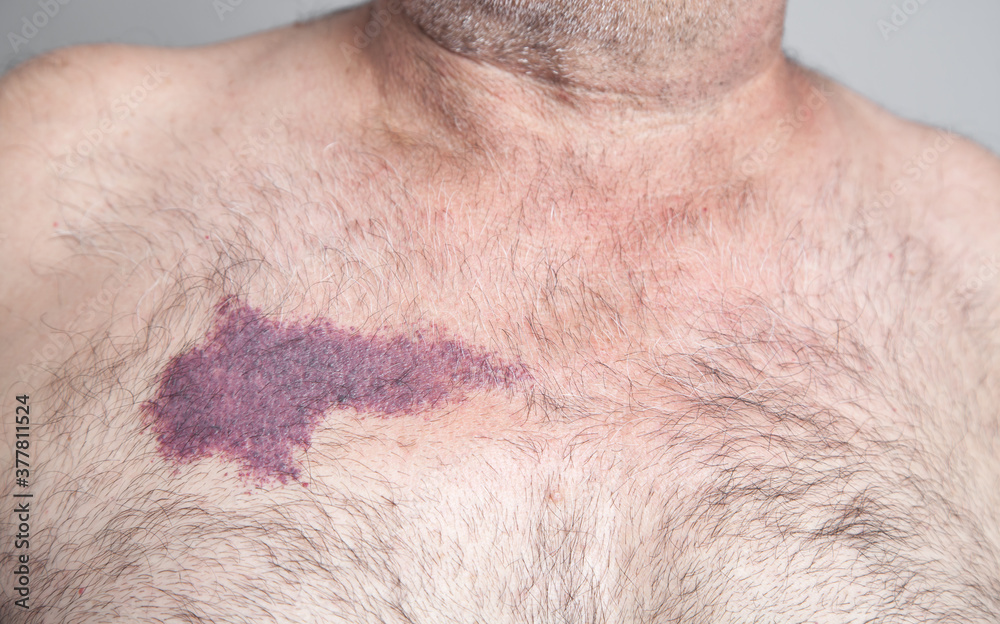 Naklejka premium Birthmark on the skin of man.