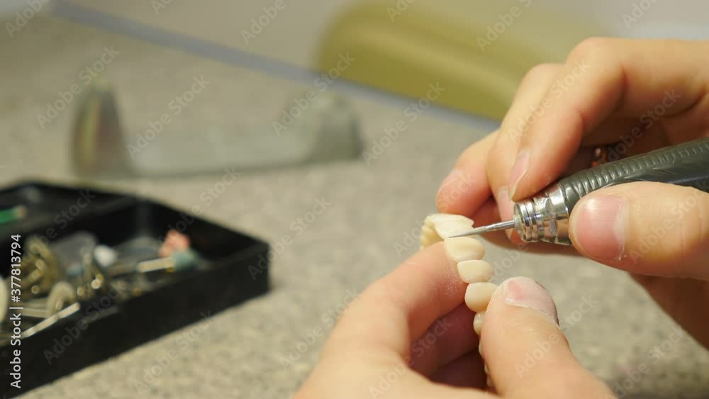 Vidéo Stock Dental prosthesis, artificial tooth, prosthetic. Dentist