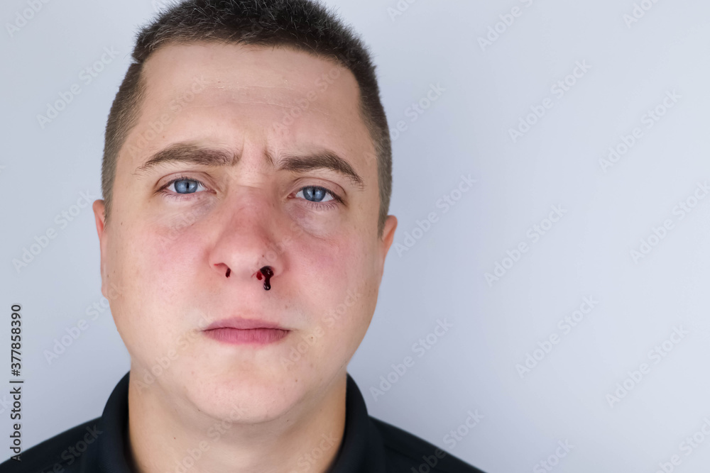 Fototapeta premium The man's nose started bleeding. High blood pressure caused blood vessels to rupture. A thin red trickle flows out of the sinuses. Consequences of vascular problems and severe stress