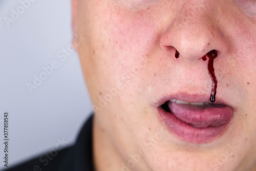 Fotografía The man is bleeding from his nose, but he smiles