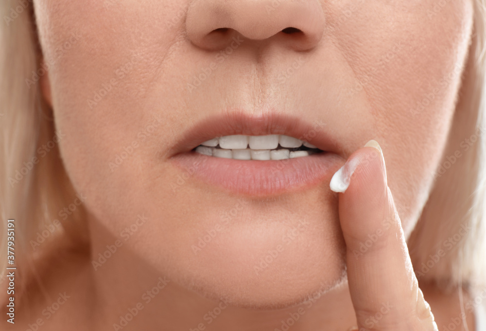 Naklejka premium Woman with cold sore applying cream on lips, closeup