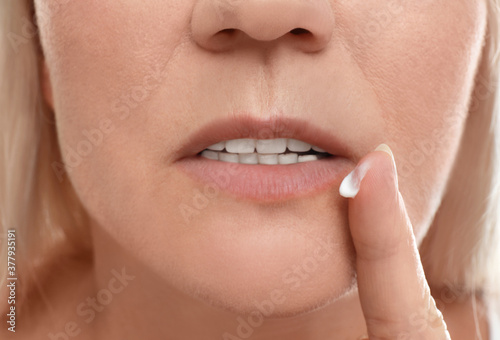 Woman with cold sore applying cream on lips  closeup