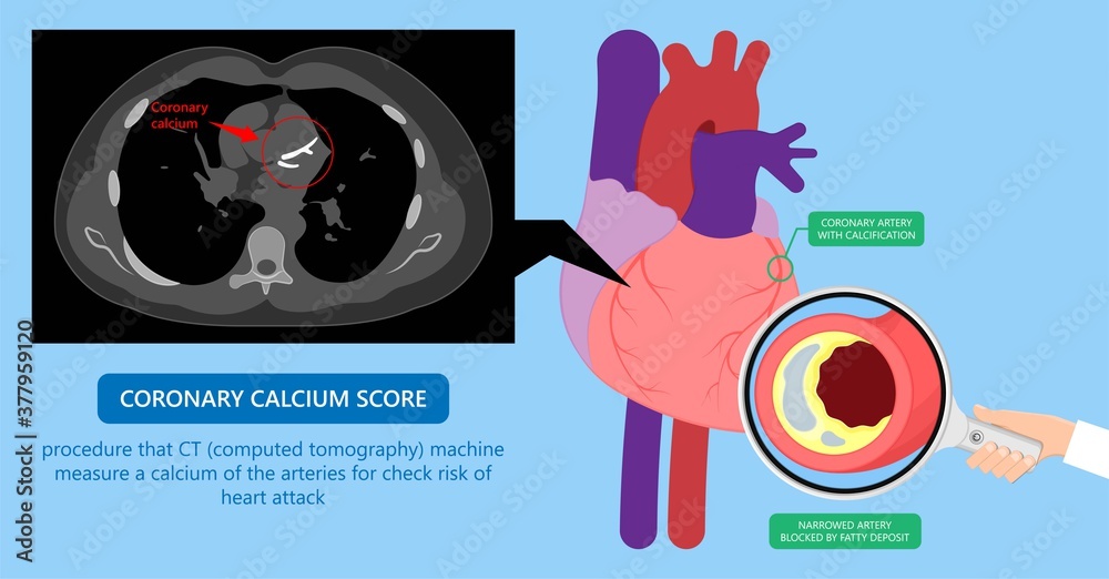Cardiac Calcium Scoring chest health signs Xray block treat blood