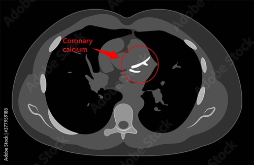 Cardiac Calcium Scoring chest health signs X-ray block treat blood Heart Score cath cell pain exam clot risk test Scan lab fat CAD CAC CT