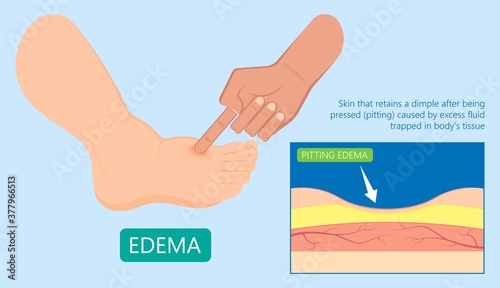 Edema swelling under the skin that affect with ankles and legs cirrhosis puffiness Stretched shiny dimple pits pressed deep vein thrombosis