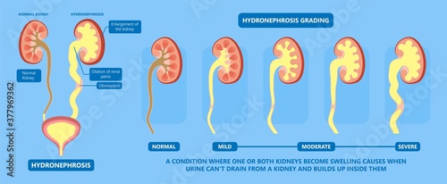kidney damage UTI scan test tube VCUG acute VUR cyst exam flow pain birth block blood fetal fetus renal stone tract treat tumor urine x-ray cancer defect pelvic pelvis reflux sample system enlarge