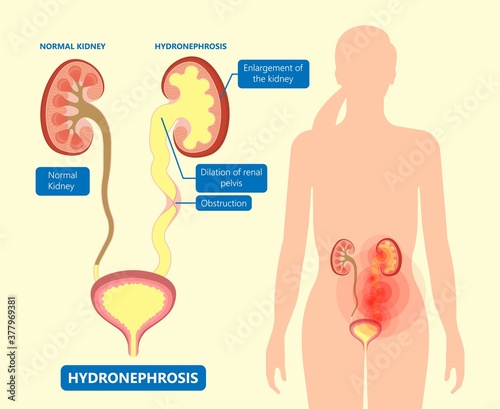 kidney damage UTI scan test tube VCUG acute VUR cyst exam flow pain birth block blood fetal fetus renal stone tract treat tumor urine x-ray cancer defect pelvic pelvis reflux sample system enlarge