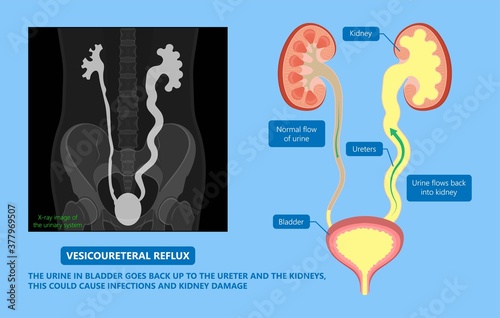 kidney damage UTI scan test tube VCUG acute VUR cyst exam flow pain birth block blood fetal fetus renal stone tract treat tumor urine x-ray cancer defect pelvic pelvis reflux sample system enlarge