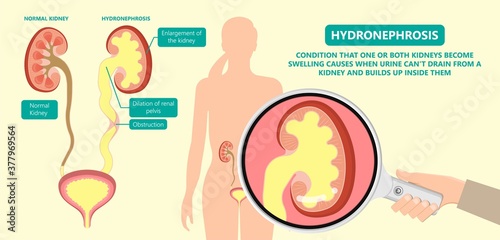 kidney damage UTI scan test tube VCUG acute VUR cyst exam flow pain birth block blood fetal fetus renal stone tract treat tumor urine x-ray cancer defect pelvic pelvis reflux sample system enlarge
