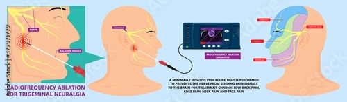 RFA low arm leg hip pain back neck knee pars bone nerve treat joint spine block Local radio needle relief branch Lumbar spinal damage pelvis therapy lateral chronic vertebra cervical surgical medial