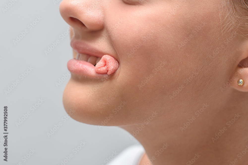 A bloody swab sticks out of the mouth of a ten-year-old girl after tooth extraction, close-up A bloody swab sticks out of the mouth of a ten-year-old girl after tooth extraction, close-up