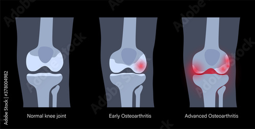 Arthritis in knee joint