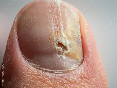 Nail infections caused by fungi such as: onychomycosis also known as tinea unguium. Thumb infection. Caused by dermatophytes and yeasts and for the concomitant antibacterial activity