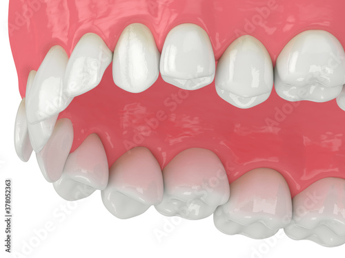 3d render of upper jaw with abnormal teeth position