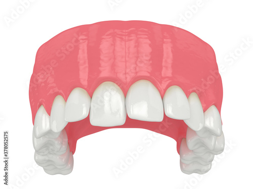 3d render of  upper jaw with abnormal teeth position photo