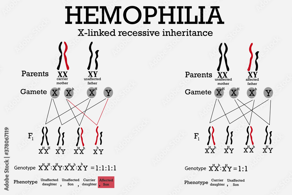 Hemophilia is a disorder which blood doesn't clot normally