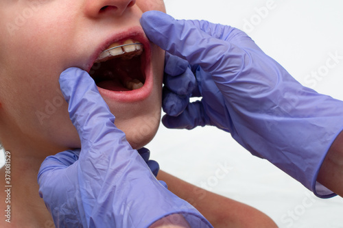 Boca de niño abierta con aparato corrector de mordida dental metálico. Dos manos con guantes de látex azules sobre las mejillas del niño
